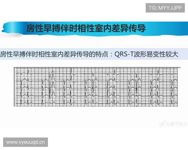 莱奥突破与终结效率的结构性差异解析
